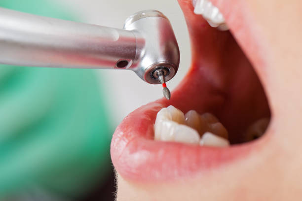 Best Emergency Gum Treatment in Nuevo, CA